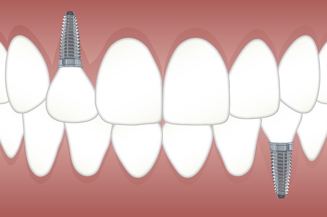 Read more about the article Zobu implantēšana un gudrības zoba raušana