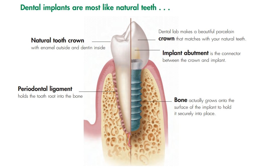 Dental-implants